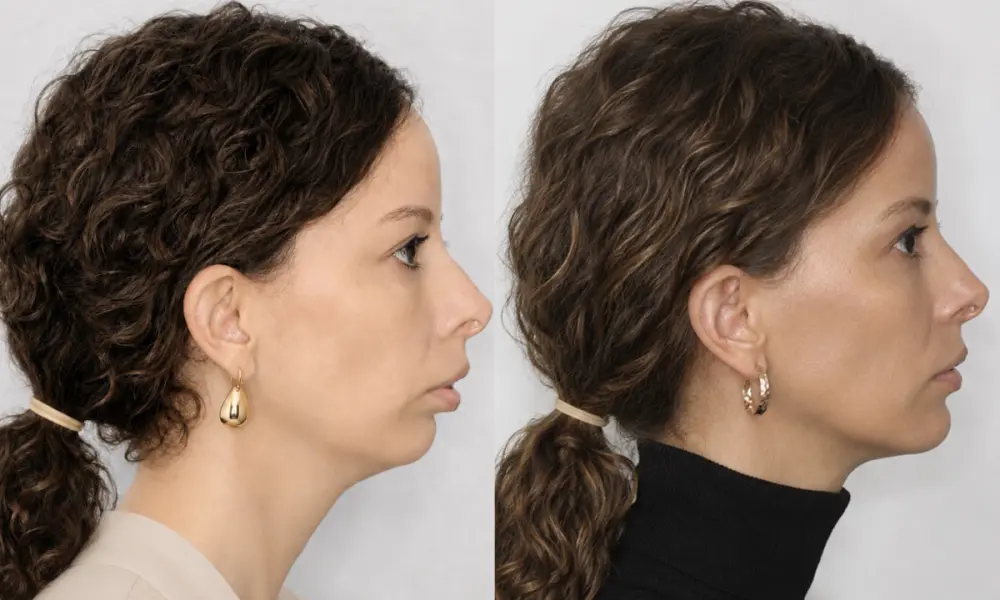 Korekce mal&eacute; brady předsunut&iacute;m horn&iacute; a doln&iacute; čelisti. Efektem je reverzn&iacute; (obr&aacute;cen&yacute;) facelift obličeje.