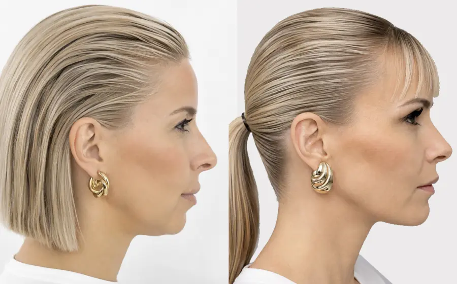 Korekce mal&eacute; brady předsunut&iacute;m horn&iacute; a doln&iacute; čelisti. Efektem je reverzn&iacute; (obr&aacute;cen&yacute;) facelift obličeje.