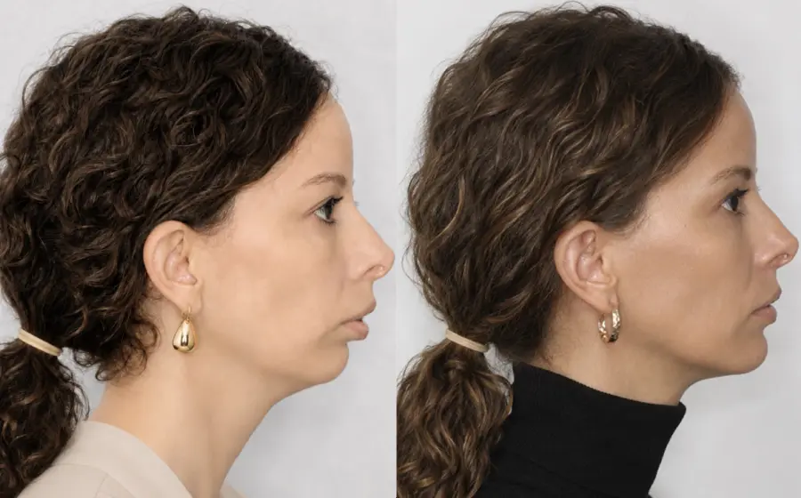 Korekce mal&eacute; brady předsunut&iacute;m horn&iacute; a doln&iacute; čelisti. Efektem je reverzn&iacute; (obr&aacute;cen&yacute;) facelift obličeje.
