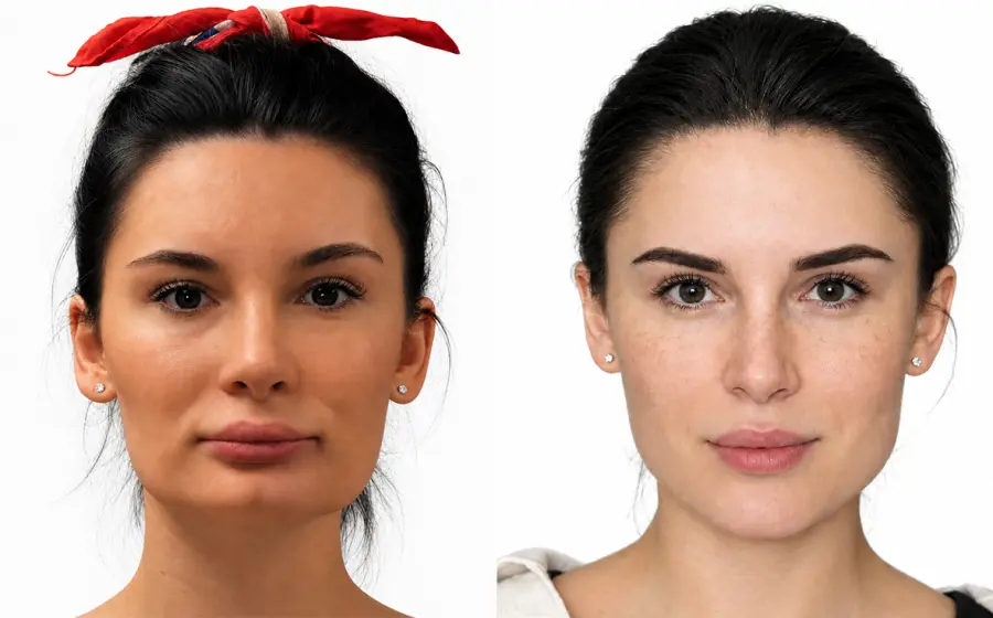 Ř&iacute;zen&aacute; &uacute;prava v&yacute;&scaron;ky doln&iacute; třetiny obličeje u klientky s kr&aacute;tk&yacute;m obličejem (Short Face Syndrome). Chirurgick&yacute;m posunem čelisti směrem dolů se obličej vertik&aacute;lně prodlouž&iacute;, doch&aacute;z&iacute; ke korekci hlubok&eacute;ho skusu a současně i k v&yacute;razn&eacute;mu zlep&scaron;en&iacute; &uacute;směvu.